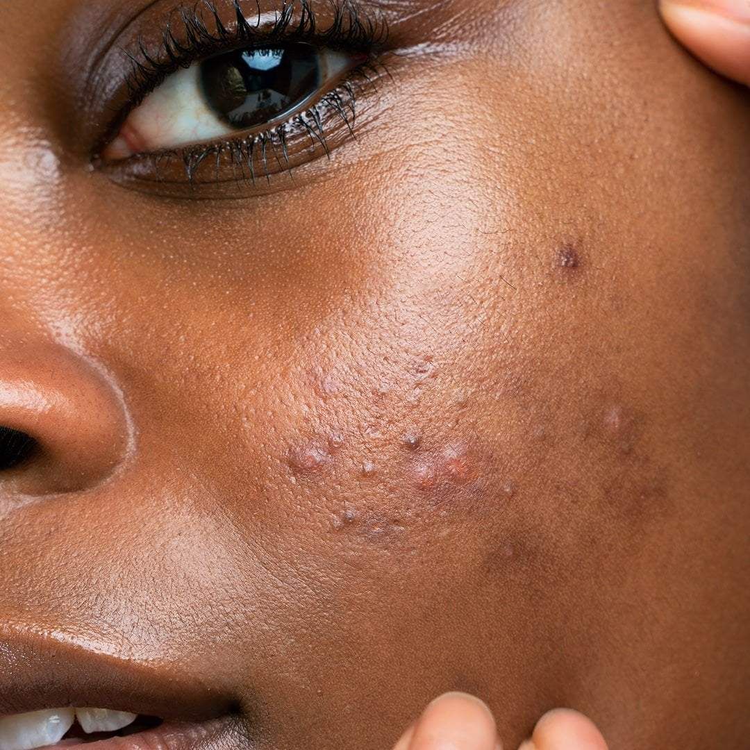 Why Your Hyperpigmentation Keeps Coming Back