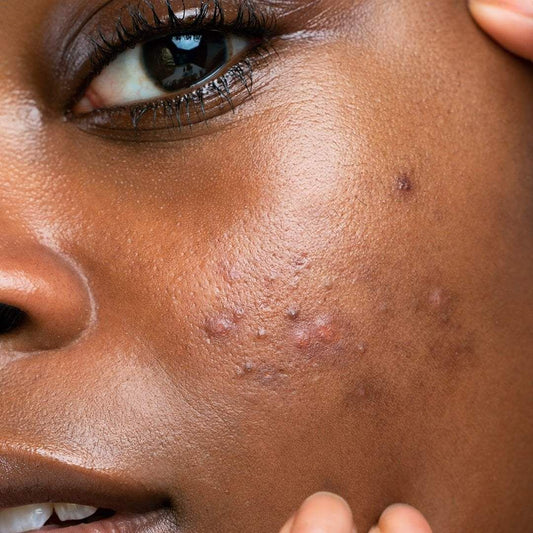 Why Your Hyperpigmentation Keeps Coming Back